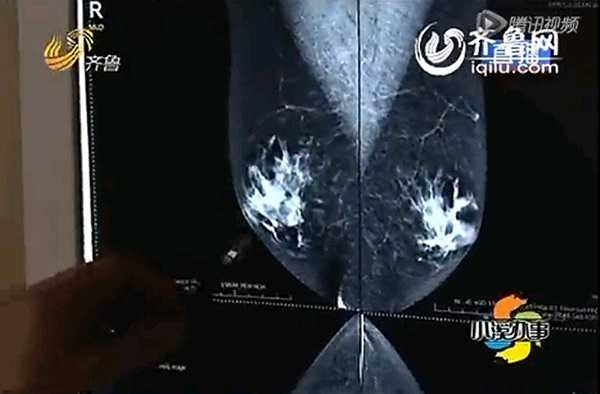 Hình ảnh X-quang bộ ngực phụ nữ của ông Tiết.