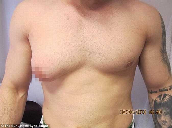 Anh Farshad Hashemzadeh, 28 tuổi, người Anh không không may mắc phải hội chứng phát triển tuyến vú ở nam giới, một dạng hội chứng hiếm gặp do rối loạn hoocmôn gây ra.