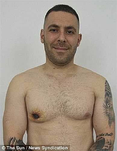 Năm 18 tuổi, anh bắt đầu nhận ra những biến đổi khác thường ở cơ thể mình. Dần dần, ngực phải của anh Farshad đã phát triển như của nữ giới. 