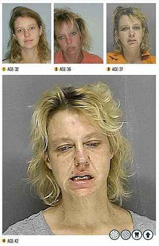 Khi sử dụng ma túy 'đá' liều lượng và cấp độ cao, người dùng sẽ bị mất ngủ, chán ăn từ 3-7 ngày liên tục, nhạy cảm với âm thanh, tiếng ồn, nói nhiều, khả năng tập trung kém, diễn đạt không logic, nặng hơn sẽ nôn ọe, chóng mặt, có cảm giác sâu bò dưới da...