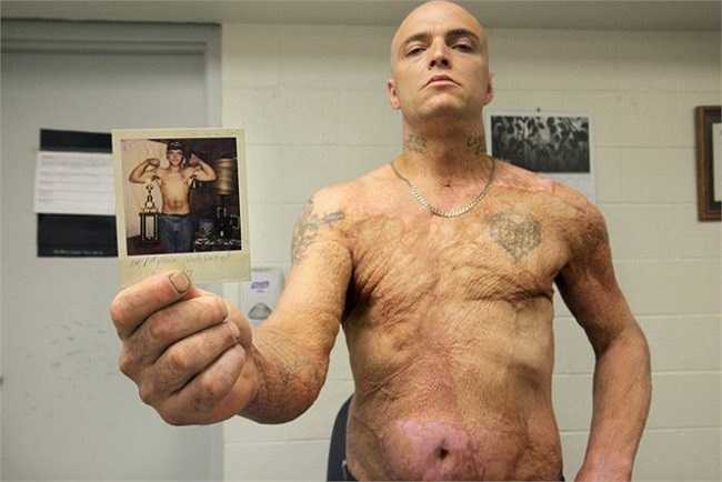 Ở Việt Nam, loại ma túy tổng hợp dạng tinh thể xuất hiện đầu tiên tại Hà Nội và TP.HCM vào những năm 2006 và 2007. Trong ảnh là một con nghiện của ma túy tổng hợp.