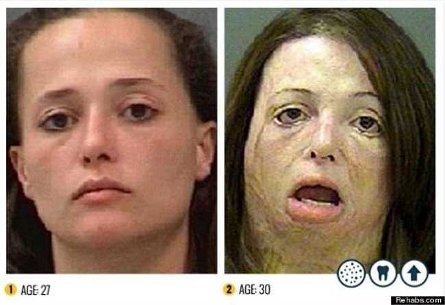 Chỉ trong 3 năm ngắn ngủi, từ 27 tuổi đến 30 tuổi, cơ thể của người phụ nữ này đã bị ma túy đá tàn phá nặng nề.