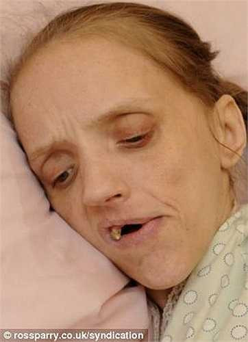 Theo số liệu từ Trung tâm chăm sóc sức khỏe cộng đồng của Anh, kể từ năm 2001 - 2009, trung bình mỗi năm tại Anh có 400 người chết vì căn bệnh gan do rượu bia gây ra.