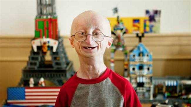 Sam Berns, chàng trai 17 tuổi nổi tiếng với căn bệnh già trước tuổi cùng nghị lực sống phi thường, đã 'trở về cát bụi' vào hôm 15/1 vừa qua.