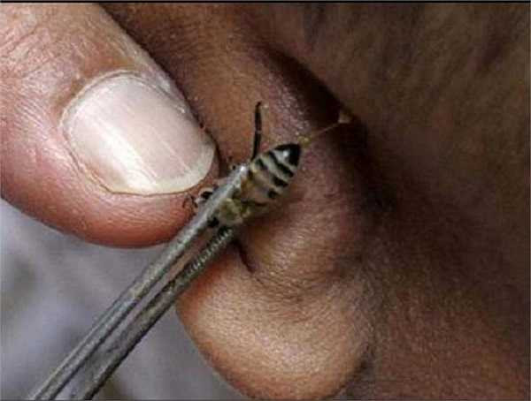 Ở Ai Cập, để ong đốt vào người giúp chữa bệnh thận, viêm ruột thừa, thậm chí là cả bệnh ung thư.