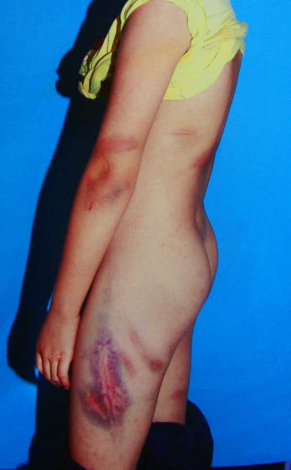 Vết roi trên người cháu Hùng Anh 