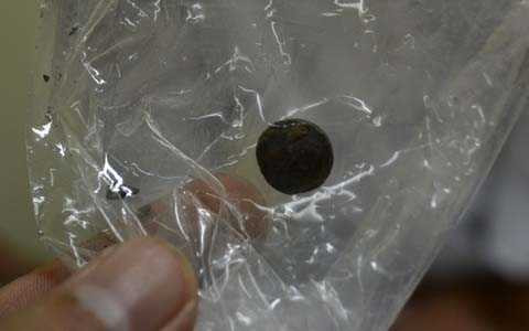 pin trong mũi, hy hữu, thăm khám, sống chung 