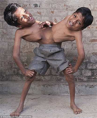 Cặp song sinh Shivanath và Shivram Sahu người Ấn Độ khiến nhiều người xúc động khi quyết định sống chung trên một cơ thể mặc dù họ đã đủ tuổi để phẫu thuật tách ra.