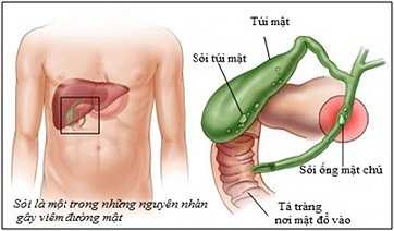 Sỏi mật: Người ăn kiêng quá mức thường không nạp đủ calo để cơ thể hoạt động, do đó, đẩy nhanh quá trình tiêu hao mỡ còn tích tụ trong cơ thể, lượng cholesterol cũng theo đó mà tăng lên, dẫn tới dịch mật tiết ra nhiều hơn, dịch này ứ đọng trong cơ thể lâu ngày gây ra sỏi mật.