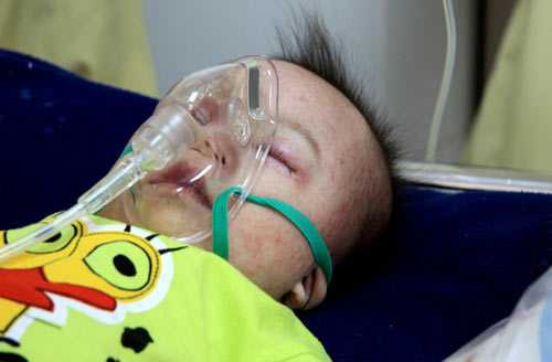  Sởi gây biến chứng nặng, trẻ phải thở máy