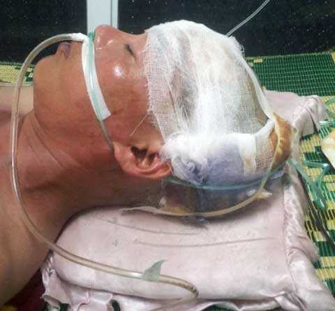 cát tặc tấn công, huyện Tứ Kỳ, Hải Dương, chấn thương sọ não