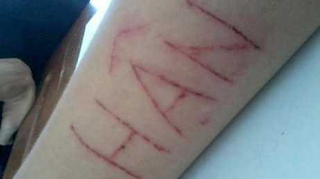 Khoe ảnh trầy da, xước thịt để thu hút sự chú ý hay muốn tìm thấy sự cảm thông? - (Ảnh minh họa).