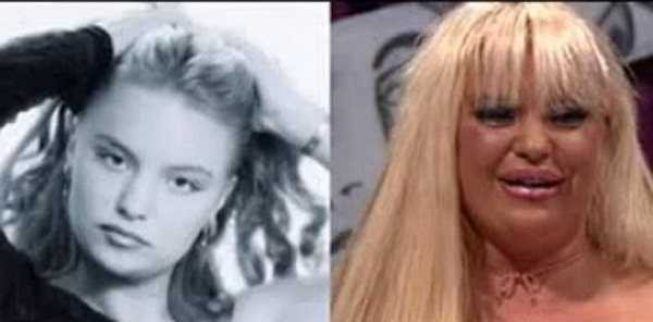 Johanna Tukiainen biến dạng sau phẫu thuật thẩm mỹ.