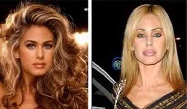 Đôi môi xấu xí sau phẫu thuật của người mẫu playboy Shauna Sand.