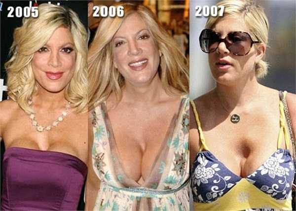 Vòng một kém thẩm mỹ của Tori Spelling.