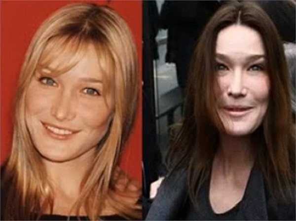 Gương mặt đơ thiếu tự nhiên của nữ diễn viên người pháp Carla Bruni.