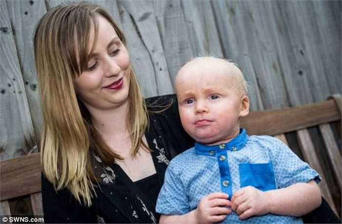 Theo phụ huynh của Daniel, để bảo vệ cho da của con, họ phải thoa kem cho con cứ cách 4 tiếng vào ban ngày, và cách 3 tiếng vào ban đêm. Ngoài ra, họ cũng phải tắm cho con từ 2 đến 3 lần mỗi ngày.