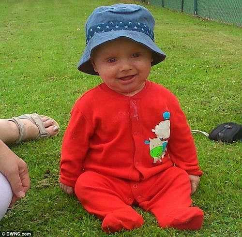 Được biết, căn bệnh cũng khiến bé Daniel không thể chớp mắt do mặt quá khô, vì thế phụ huynh của bé phải thường xuyên nhỏ mắt cho con.