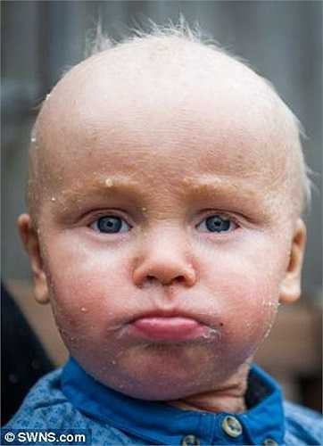 Kể từ khi mắc chứng bệnh này, bé Daniel thường xuyên phải ra vào bệnh viện để điều trị.