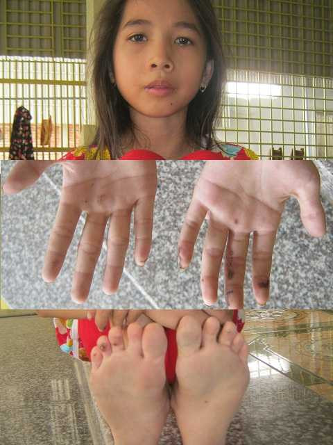 Vật lộn 2 giờ dưới giếng sâu, bé gái thoát cửa tử