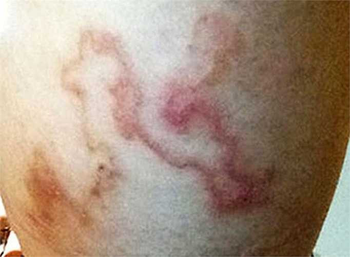 Loài giun lươn xâm nhập vào cơ thể, bò lổn nhổn dưới da người được ghi nhận là loài có tên khoa học là Strongyloides Stercoralis. Con người tiếp xúc nhiều với đất, vật nuôi mà không đeo găng tay là nguyên nhân khiến ấu trùng sống trong đất và động vật chui vào trong da, ngoài ra ấu trùng ký sinh trong các đồ hải sản song 