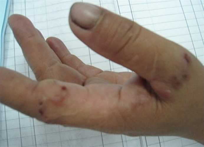 Dấu hiện nhận thấy loài giun lươn ký sinh trên người là những đường ngoằn ngoèo ở da, bầm máu, nổi mề đay. Biểu hiện ở đường tiêu hoá như đau bụng, tiêu chảy, ngứa hậu môn, sụt cân nhẹ… nên người nhiễm giun lươn thường bị suy kiệt cơ thể vì chúng hút hết chất 