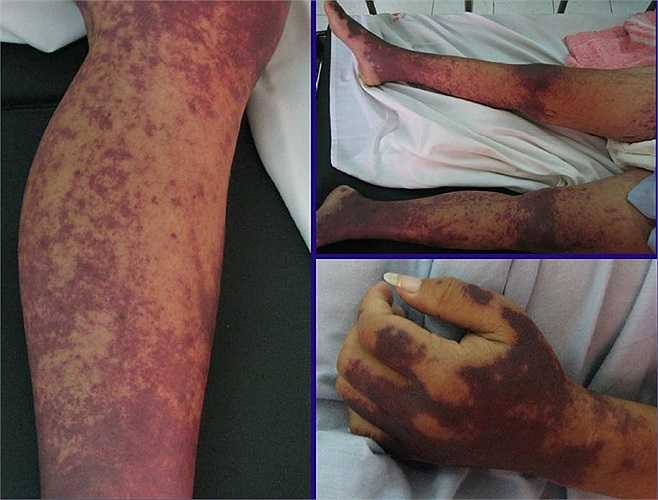 Bệnh nhân bị liên cầu khuẩn lợn, dẫn tới nhiễm trùng huyết suy đa tạng, có nhiều ban hoại tử đen toàn thân, đặc biệt là ở mặt. Theo thông tin từ Bệnh viện bệnh Nhiệt đới TW, từ đầu năm 2014 đến nay, Bệnh viện này tiếp nhận gần 10 ca bệnh liên quan đến liên cầu khuẩn lợn.