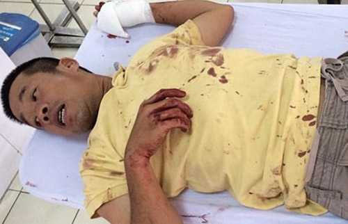 Anh Phi bị chém, phải vào bệnh viện cấp cứu. (Ảnh do gia đình anh Phi cung cấp)