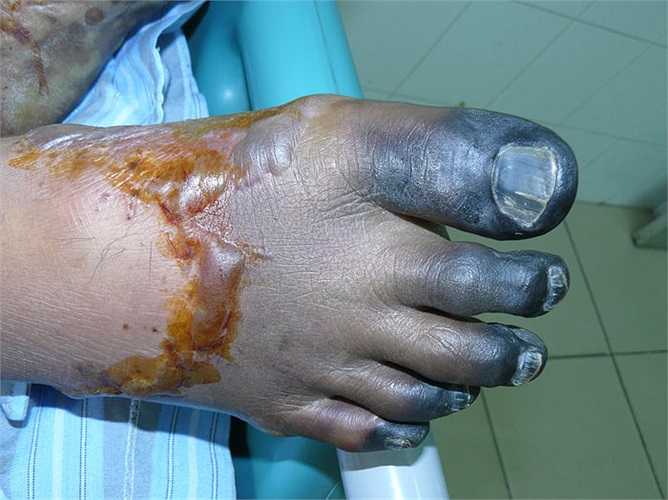 Tập quán ăn tiết canh ở Việt Nam có từ lâu đời. Đặc biệt, cánh mày râu rất thích món này. 