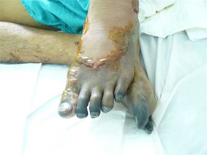 Tuy nhiên, trong mỗi bát tiết canh ẩn chứa nhiều mối nguy hiểm đến tính mạng. Nhiều người là nạn nhân của tiết canh lợn.