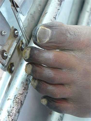 Với người chế biến lợn nhiễm liên cầu khuẩn cũng có nguy cơ mắc phải do tay chân bị xước tiếp xúc với dịch, máu của lợn bệnh”. Tuy nhiên, khi cùng ăn tiết canh một con lợn bị liên cầu khuẩn nhưng không phải ai cũng phát bệnh. Tùy cơ địa, sức đề kháng mỗi người mà người đó có bị phát thành bệnh hay không.