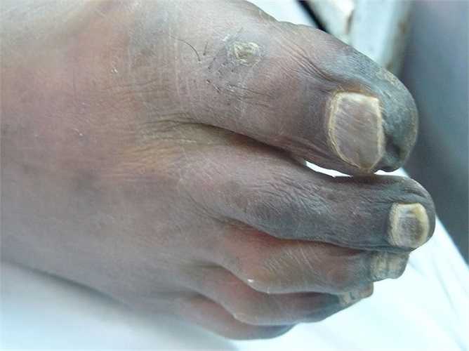 Một số trường hợp xuất hiện các triệu chứng nhiễm khuẩn, nhiễm độc tiêu hoá với triệu chứng sốt, đi cầu nhiều lần, phân lỏng, cơ thể lạnh, run... trước khi có biểu hiệu của viêm màng não. Với trường hợp bị nhiễm trùng huyết, bệnh nhân sốt cao liên tục, phát ban hoại tử từ màu hồng cánh sen, chuyển sang đỏ tím, lan ra toàn thân rồi hoại tử đen.