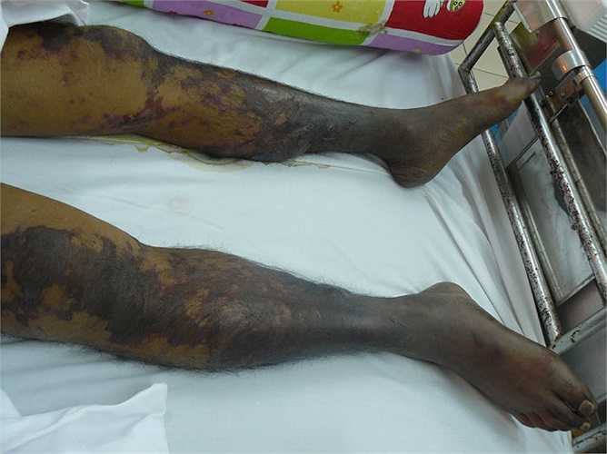 Nếu nặng, bệnh nhân có thể bị sốc nhiễm độc, trụy mạch, cơ thể lạnh, tụt huyết áp, nhiễm khuẩn huyết cấp tính, rối loạn đông máu nặng, suy hô hấp, suy đa phủ tạng... hôn mê và tử vong. 