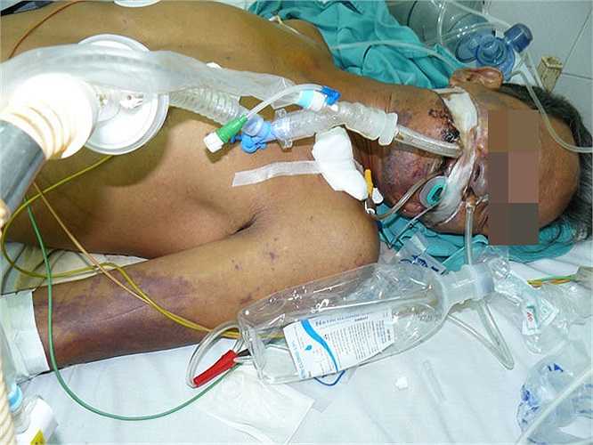 Vài hình ảnh về nạn nhân của tiết canh lợn.