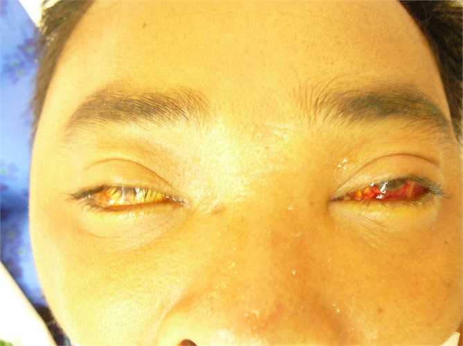 Theo thông tin từ Bệnh viện bệnh Nhiệt đới TW, từ đầu năm 2014 đến nay, Bệnh viện này tiếp nhận gần 10 ca bệnh liên quan đến liên cầu khuẩn lợn. 