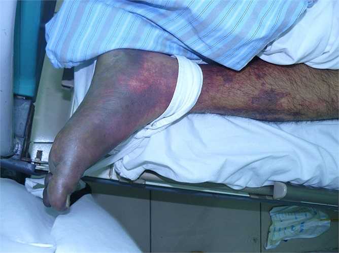 Vi khuẩn này thường cư trú ở đường hô hấp trên đặc biệt là xoang mũi, tai, hầu họng lợn. 