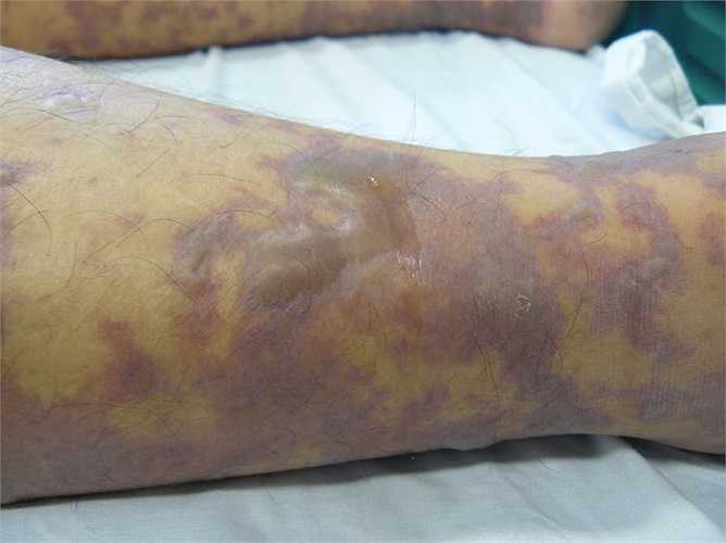 Tuy nhiên, vi khuẩn cũng có thể có trong đường tiêu hóa và đường sinh dục của lợn. 