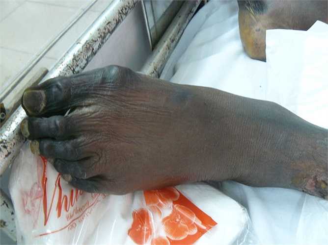 Trong một đàn lợn khỏe, cũng có một tỷ lệ nhất định các cá thể lợn mang vi khuẩn. Khi lợn bị ốm, sức đề kháng bị suy giảm thì liên cầu khuẩn mới gây viêm phổi hoặc nhiễm trùng huyết ở lợn. Như vậy, nhìn con lợn khỏe mạnh cũng không chắc rằng con lợn đó không mang trong người liên cầu khuẩn. 