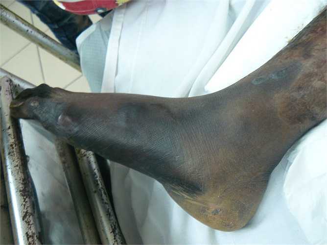 Đó là lý do tại sao, có những gia đình tự nuôi lợn, thấy lợn rất khỏe mạnh nhưng khi ăn tiết canh vẫn mắc liên cầu khuẩn và tử vong.