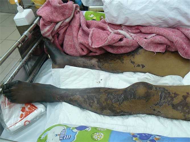 Bác sỹ Cấp nói: “Ở những con lợn khỏe mang liên cầu khuẩn, khi cắt tiết ở vùng cổ, vi khuẩn liên cầu khu trú ở dịch hầu họng lợn bị nhiễm sang tiết canh nên người ăn bị bệnh. Cũng có thể, cuống họng được dùng để đánh tiết canh chưa được nấu chín hẳn có chứa liên cầu khuẩn nên người ăn bị nhiễm.