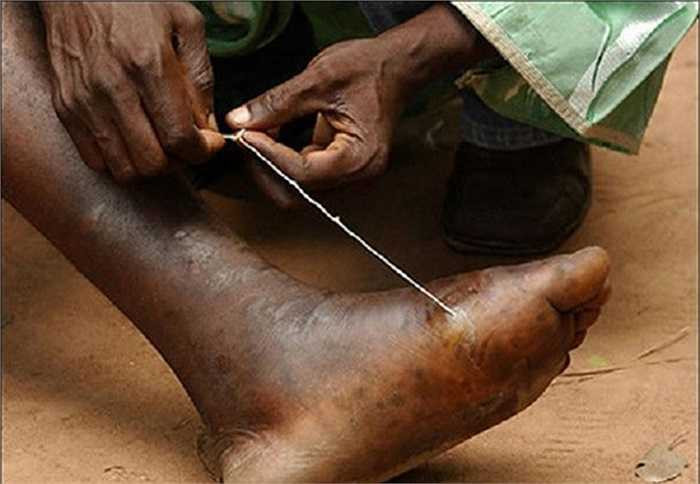 Giun Guinea có tên khoa học là Dracununculus medinensis – là một loại ký sinh trùng ở da người và động vật.