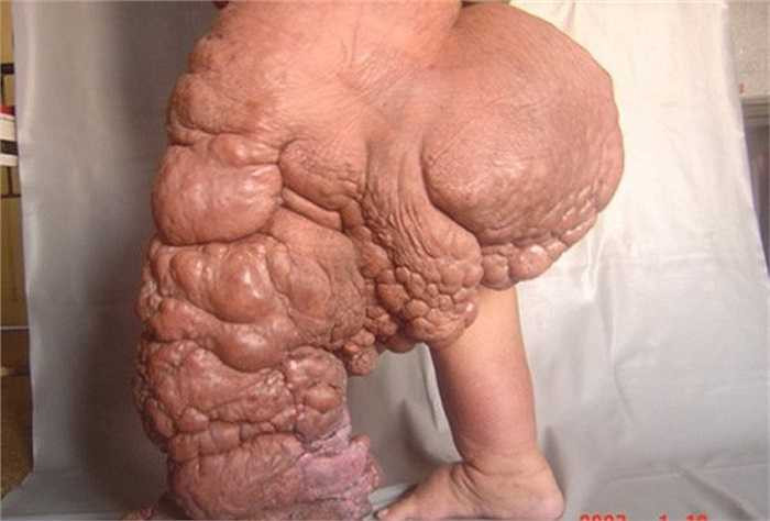 Giun chỉ là một trong những loài ký sinh đáng sợ và nguy hiểm nhất với con người. Sự tấn công của giun chỉ trong mạch bạch huyết sẽ gây phù nề hệ thống hạch bạch huyết. Khi đó, một số vùng của cơ thể như chân, tay, bộ phận sinh dục bị sưng to quá mức.