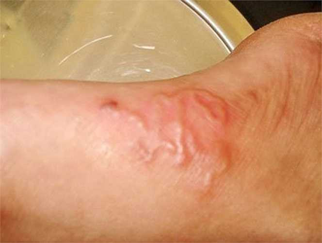 Giun lươn là một loại giun tròn nguy hiểm nhất trong các loại ký sinh trùng đường tiêu hóa ở người. Khi cơ thể chúng ta bị suy giảm miễn dịch thì chúng phát triển rất mạnh, phát tán đến nhiều cơ quan gây nên biến chứng nguy hiểm, thậm chí có thể tử vong.