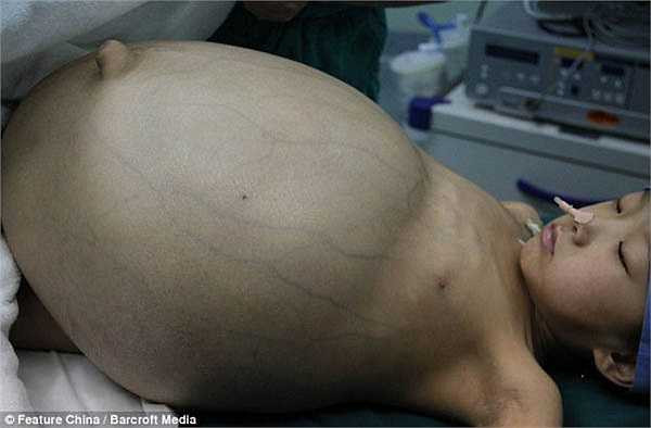 Han Bingbing, 11 tuổi người Trung Quốc vừa trải qua ca phẫu thuật kéo dài 8 tiếng để loại bỏ khối u khổng lồ trong bụng.