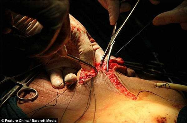 'Năm ngoài, khối u bắt đầu phát triển nhanh hơn và lớn gần bằng 2 quả bóng, khi đó không có bệnh viện nào chịu nhận điều trị nữa'.