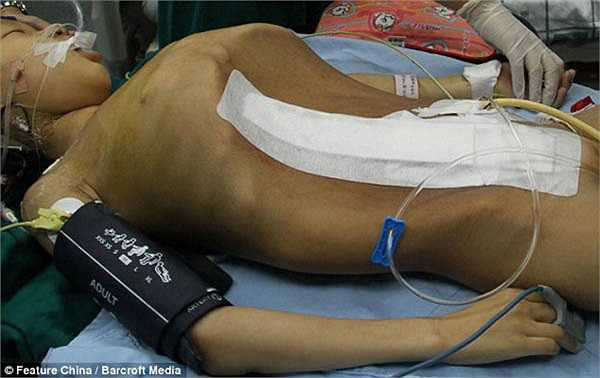 Hình ảnh bé Han Bingbing sau khi phẫu thuật xong.