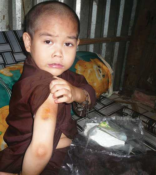  Cháu Trần Trung Bảo bị cha đánh bầm tím tay