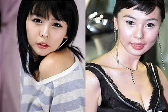 Chiếc cằm biến dạng của Lee Ji Woo là dấu hiệu của phẫu thuật thẩm mỹ. 