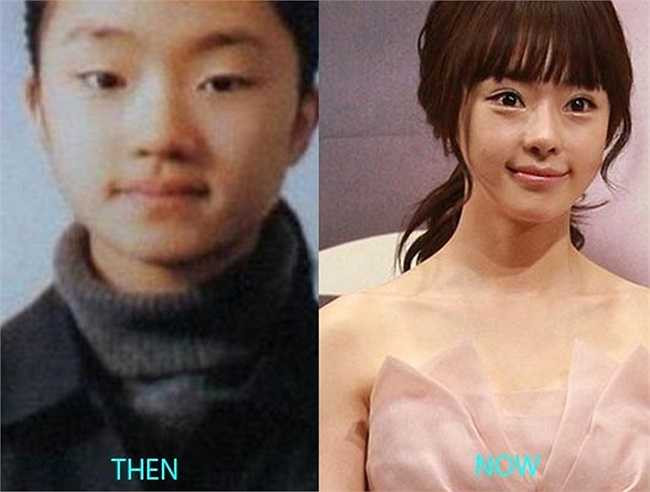 Diễn viên của 'Chị kế của Lọ Lem' - Seo Woo cũng sửa hầu như trọn vẹn khuôn mặt như cắt mí, sửa mũi và nâng cằm.