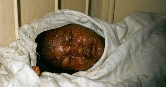 Tiếp đó, người bệnh ói mửa, tiêu chảy, phát ban, suy giảm chức năng gan và thận.